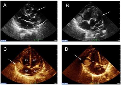 Analysis of the Risk Factors in Prognosis of Kawasaki Disease With Coronary Artery Lesions